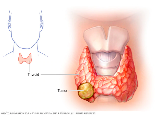 People with low risk thyroid cancer can receive lower doses of radiation treatment Study