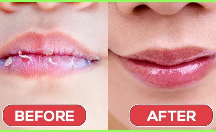 Home remedies for chapped lips