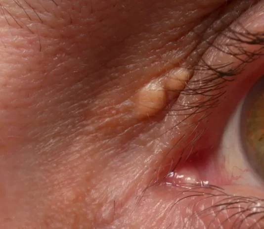 Get Rid of Cholesterol Deposition (xanthelasma)