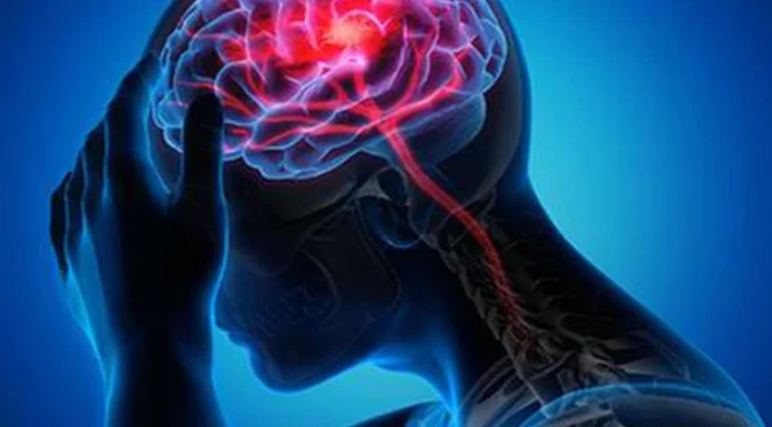 Stroke could cause about 10 million deaths annually by 2050