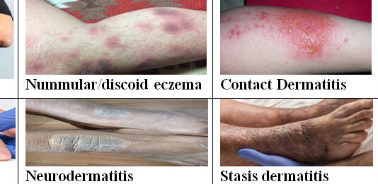 Eczema