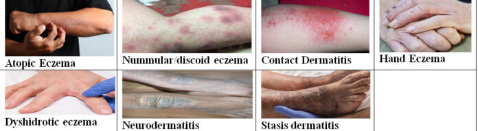 Eczema