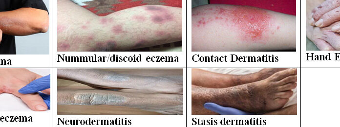 Eczema