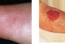 Cellulitis