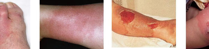 Cellulitis