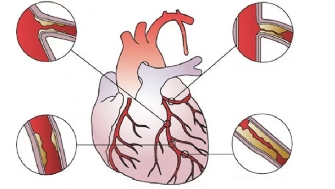 How to treat heart blockages without surgery heart blockages