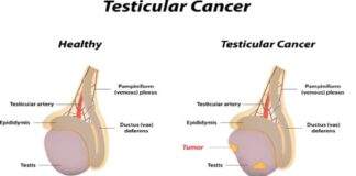 Testicular Cancer