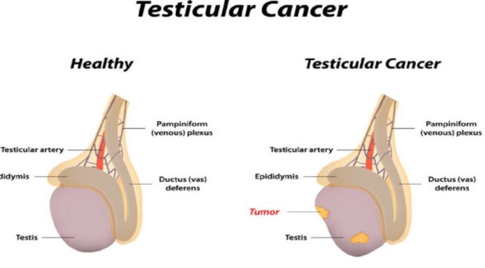 Why young men must be aware of testicular cancer Testicular Cancer